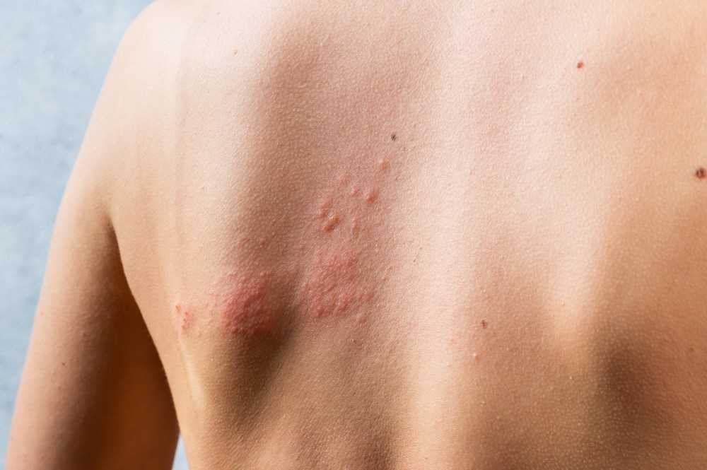 Culebrilla: El virus que vive en tu cuerpo 50 años