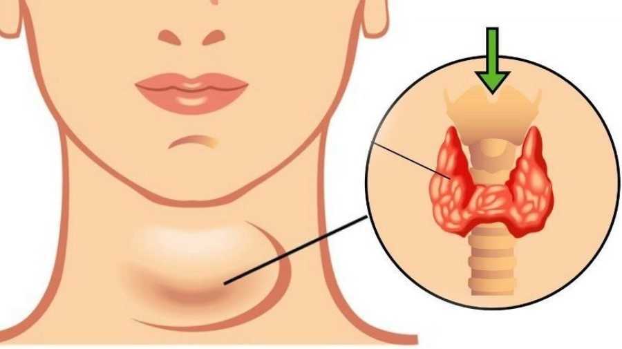 Hipotiroidismo controlado
