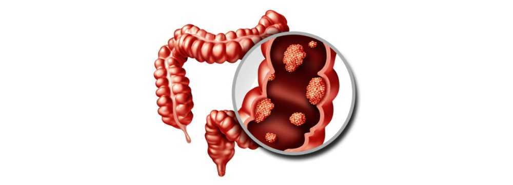 Cáncer de colon en 2026