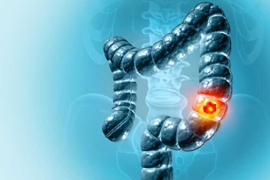 Cáncer de colon en 2026